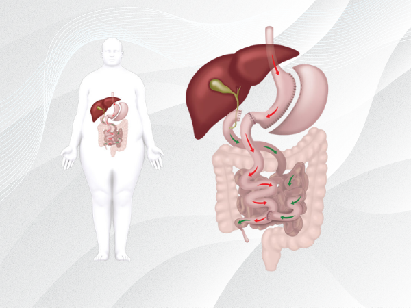 Biliopancreatic Diversion